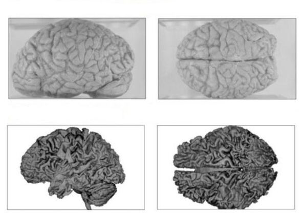 Ο εγκέφαλος ενός υγιούς ανθρώπου (πάνω) και ο εγκέφαλος ενός αλκοολικού με μη αναστρέψιμες συνέπειες (κάτω)